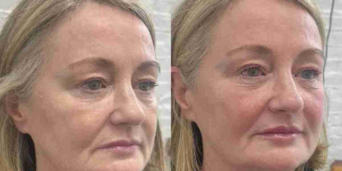 Rediscover Your Youth with Dermal Fillers in Islamabad