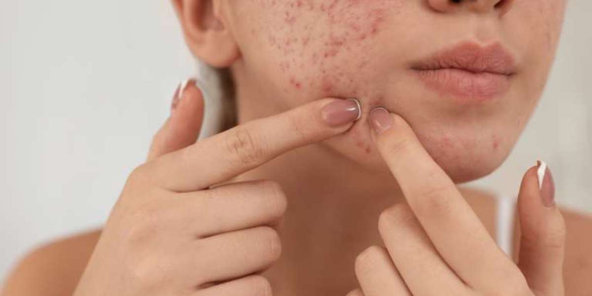 Expert Pimples Treatment in Islamabad