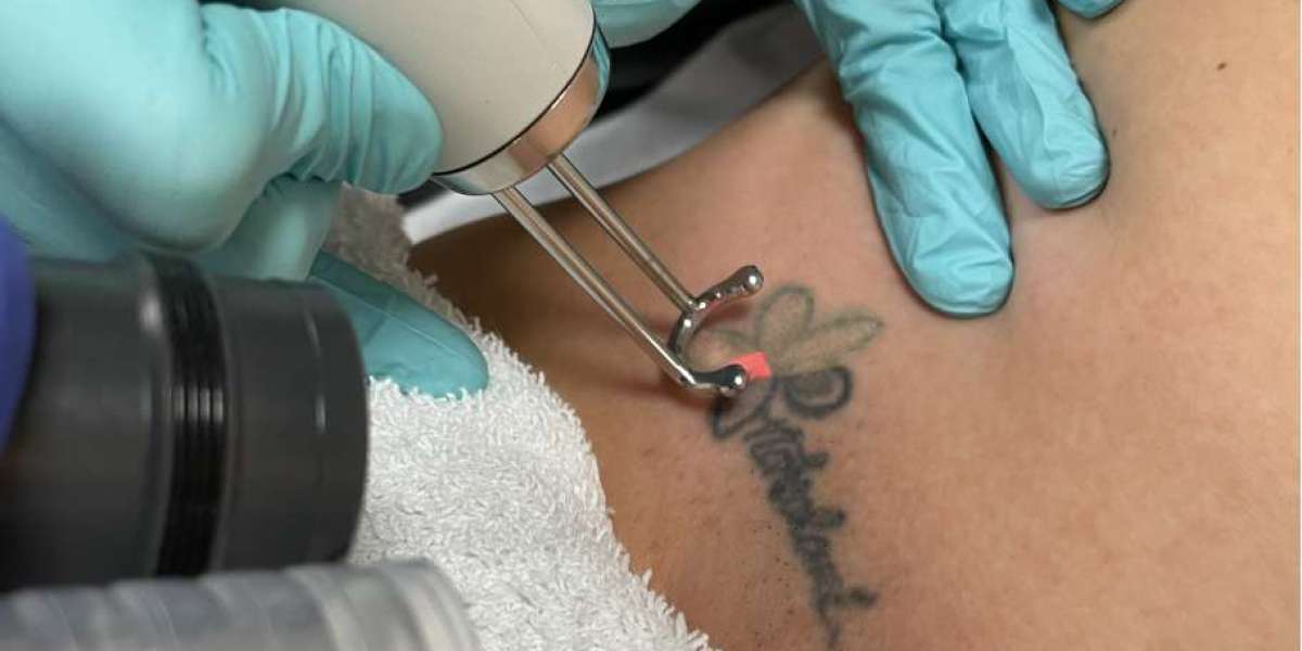 Laser Tattoo Removal Dubai: Latest Trends & Techniques